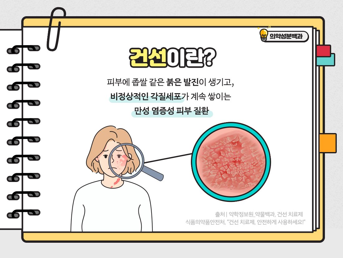 건선 관리 수칙과 도움을 줄 수 있는 방법