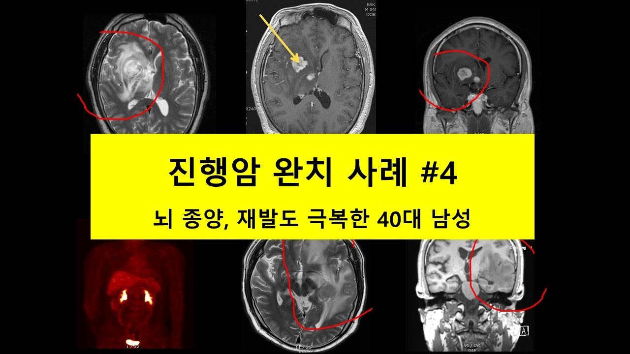 10년의 쉼과 재발의 현실